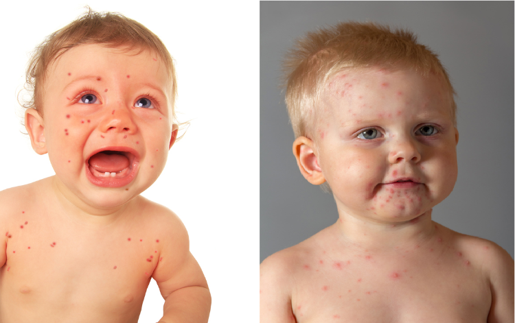 dvě děti: jedno s výsevem, druhé má plané neštovice